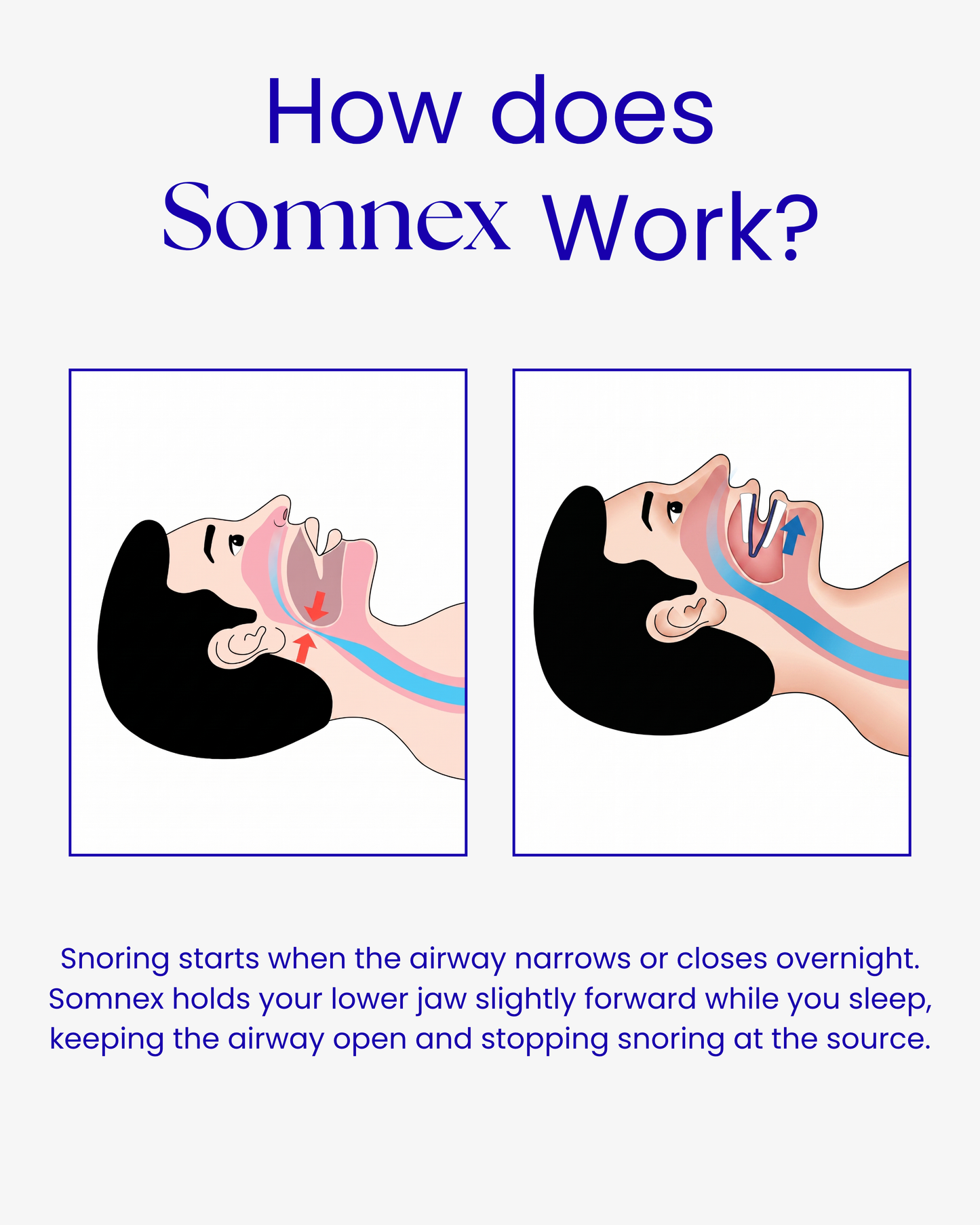 Somnex Pro™ Anti-Snoring Mouthpiece