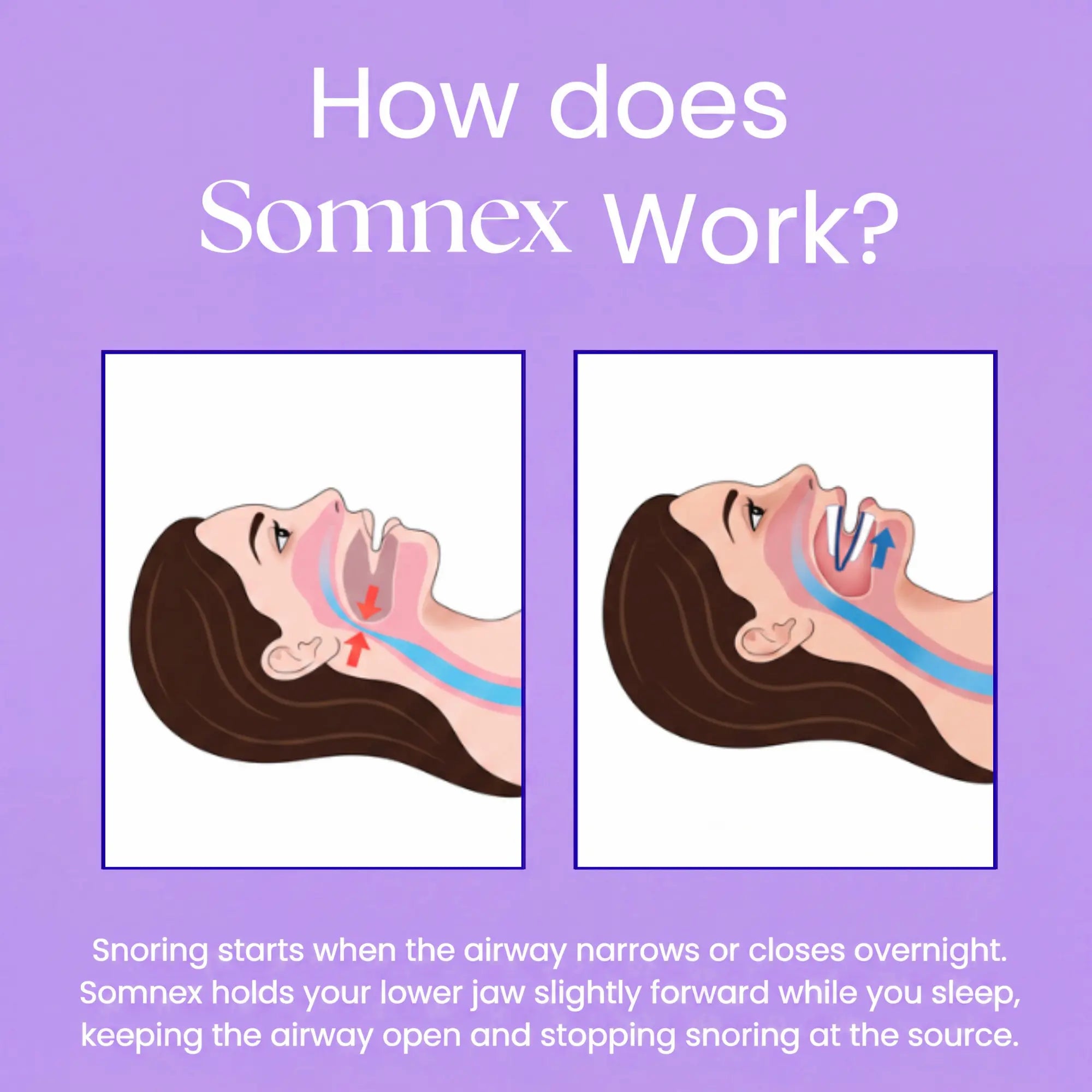 Somnex Pro™ Anti-Snoring Mouthpiece